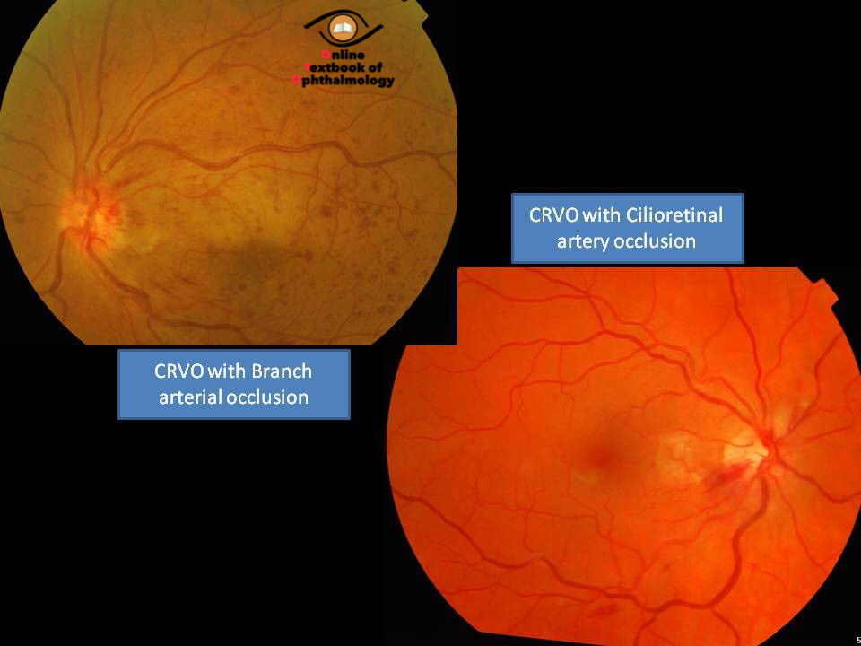 Central Retinal Vein Central Retinal Vein Occlusion In The Setting Of