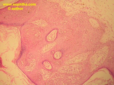 hyperkeratosis with parakertosis