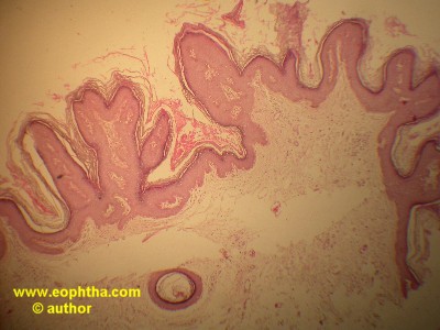 hyperkeratosis