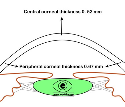 refractive