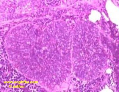 sebaceous cell carcinoma