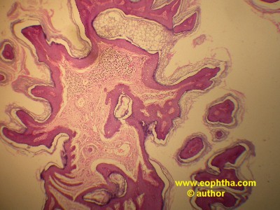 squamous papilloma