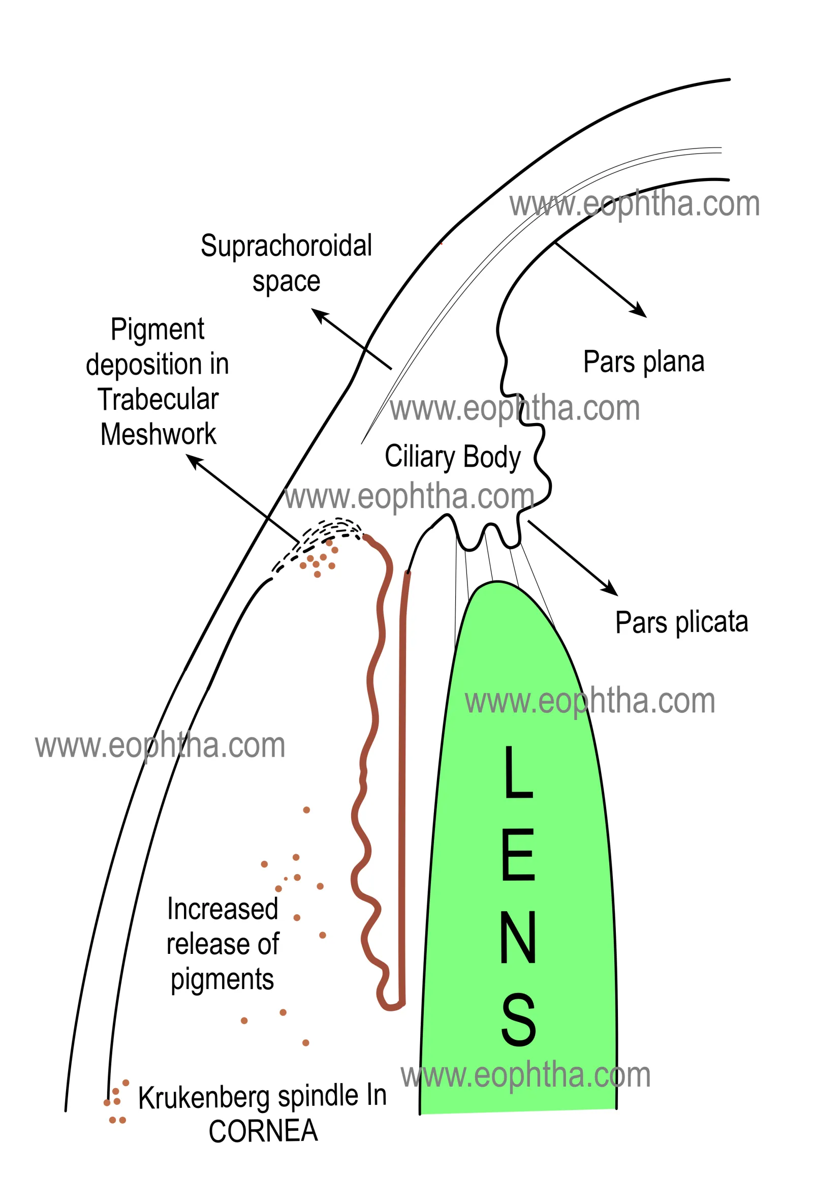 pigment dispersion glaucoma