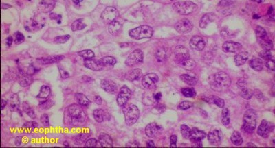 sebaceous cell carcinoma