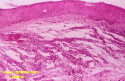 pterygium