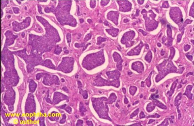 Basal cell carcinoma