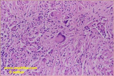 langerhans giant cell