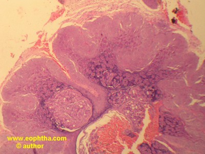 molluscum contagiosum