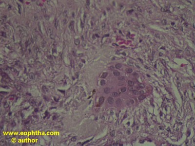 giant cell