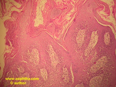 parakeratosis
