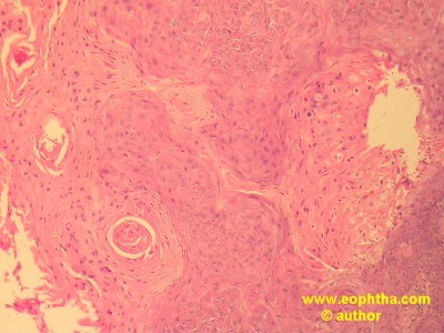 squamous cell carcinoma